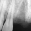 x-ray of left teeth