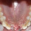 Palatal view of missing front maxillary 2 teeth