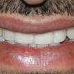 Replaced teeth with dental implants & permanent teeth